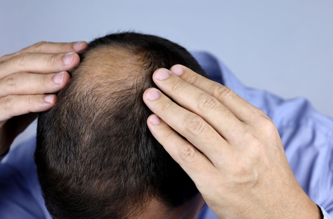 coping with male hair loss