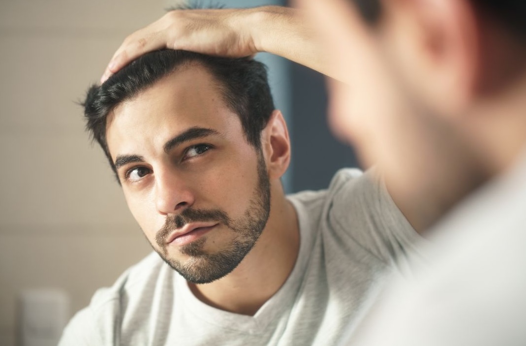 male hair loss acceptance