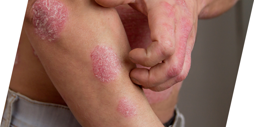 Eczema/Psoriasis