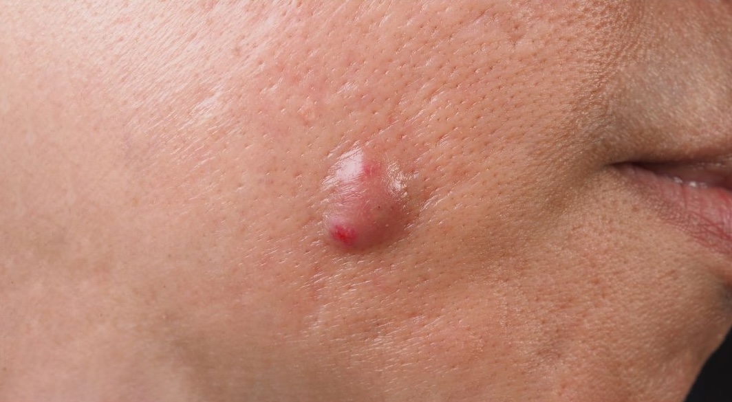 acne cysts