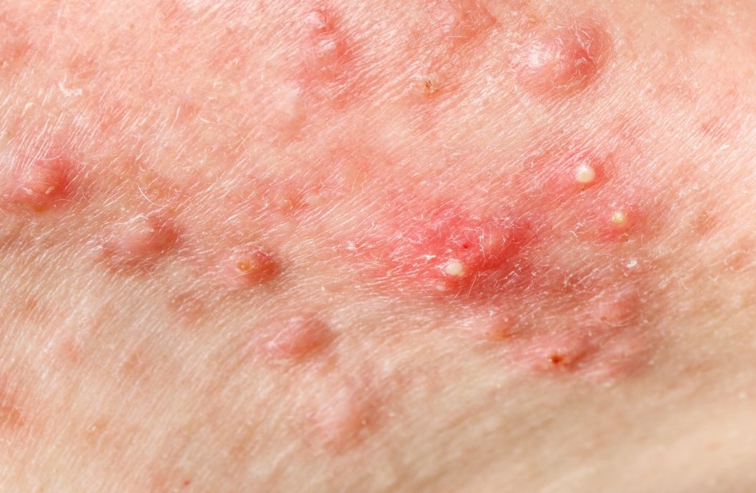 acne nodules