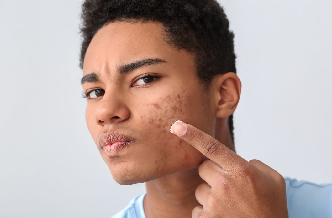 man putting on treclin gel