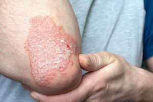 psoriasis flare-up