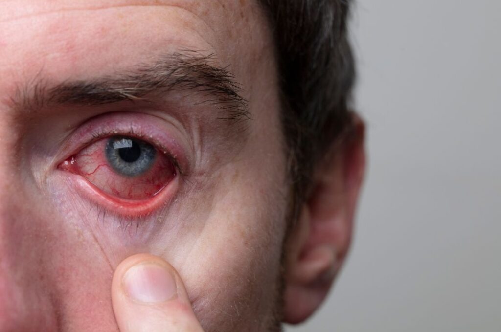 hayfever eyes