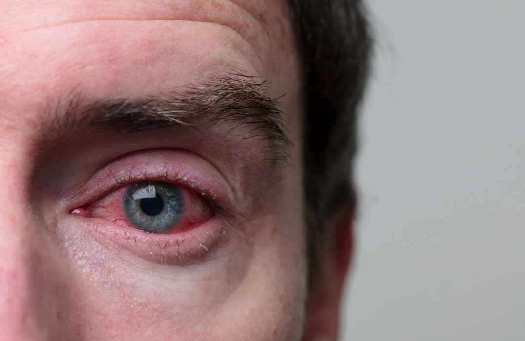 red swollen puffy eyes