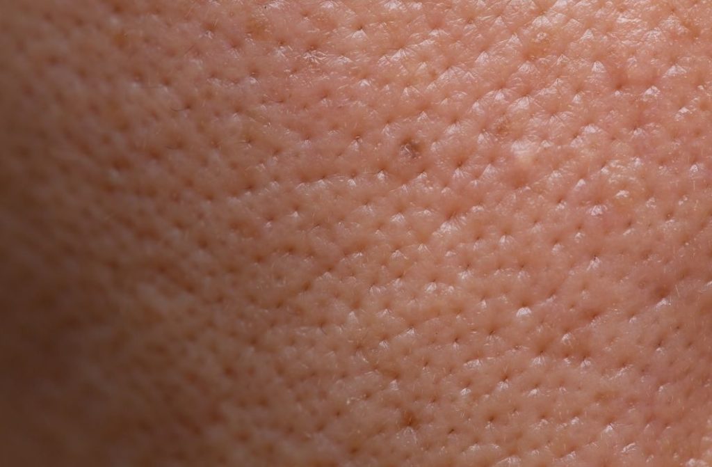 clogged pores