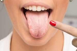 oral thrush