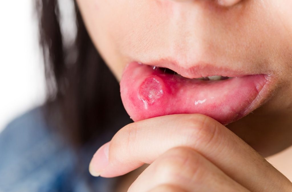 sores inside mouth