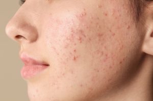 facial acne