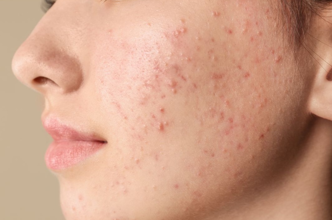 facial acne