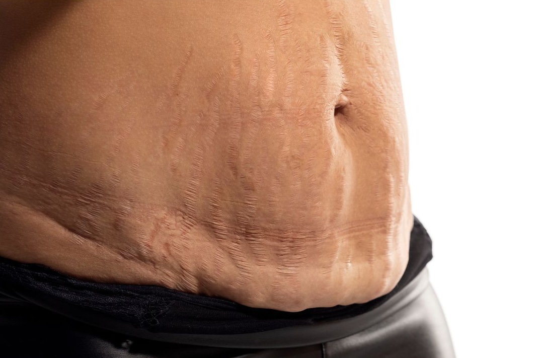 deal with loose skin after weight loss