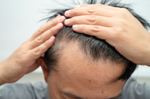 male hair loss hormones