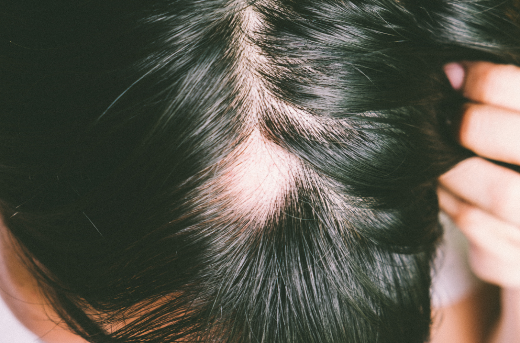 male hair loss oestrogen imbalance